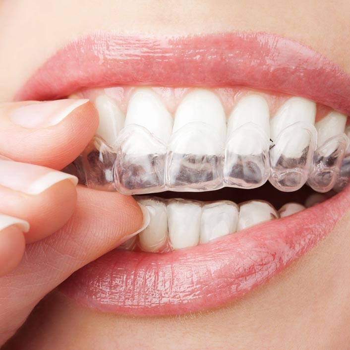 Folsom Invisalign